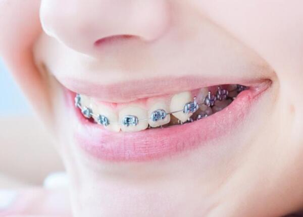 戴了牙套可以用电动牙刷吗？戴牙套的人群必看！