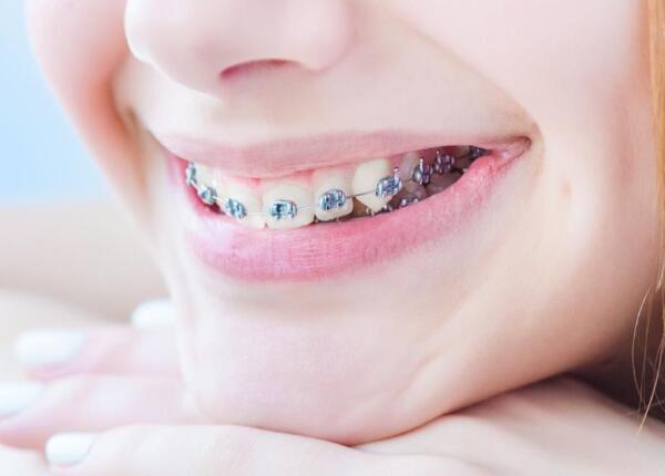 佩戴牙齿矫正器 成人声波电动牙刷使用禁忌1