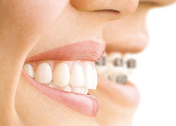 牙齿矫正者 成人声波电动牙刷使用注意事项