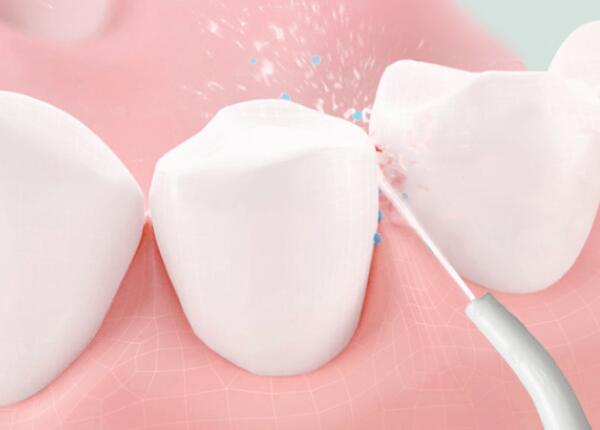 洗牙后用洗牙器好还是电动牙刷？口腔清洁工具这样?。? width=