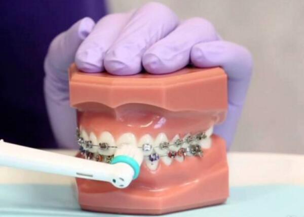 卸了牙套能用电动牙刷吗？答案就在这篇文章